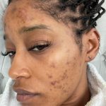 Hyperpigmentation